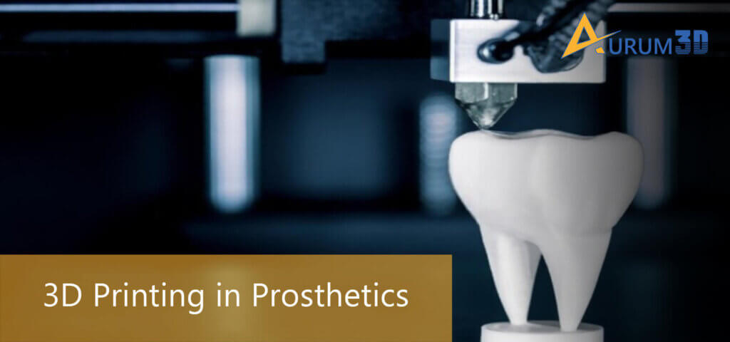 3D Printing in Prosthetics